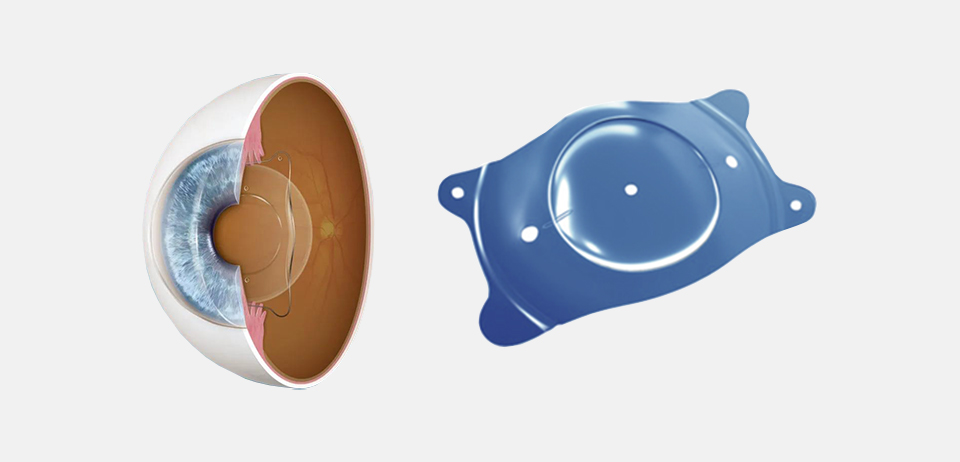 ICL人工晶體植入術