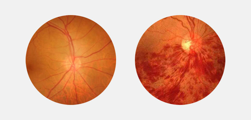 眼底病